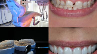 Why Istanbul Has Become the Preferred Destination for Smile Makeovers ?
