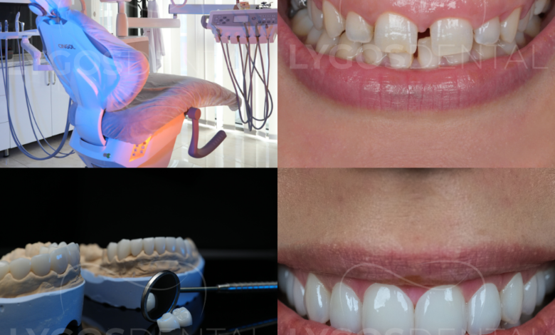 Why Istanbul Has Become the Preferred Destination for Smile Makeovers ?